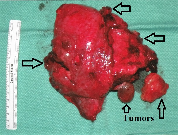 Sarah's Lung